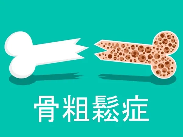 骨粗鬆症を予防!骨の健康度チェックと日常生活の対策