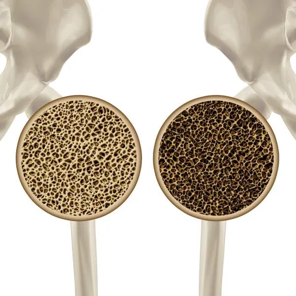 骨粗鬆症（こつそしょうしょう）とは？メカニズムを解説